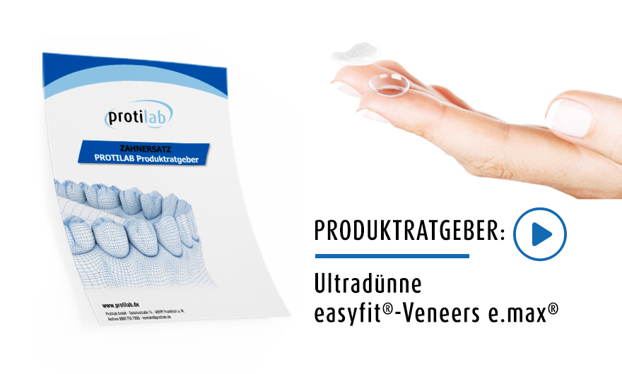 Produktratgeber: Ultradünne easyfit®-Veneers e.max®