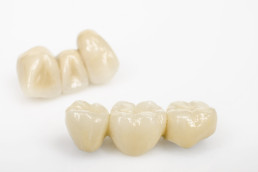 Dental,Bridges,,Ceramics