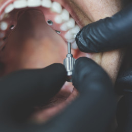 Prothèses-sur-implants-Protilab